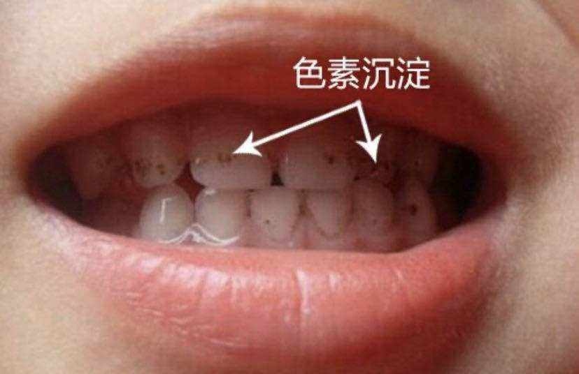 人的牙齿为什么会掉(人的牙齿为什么会蛀牙)