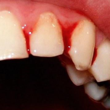 为什么牙齿会突然出血(为什么牙齿会突然出血是什么原因) 第2张