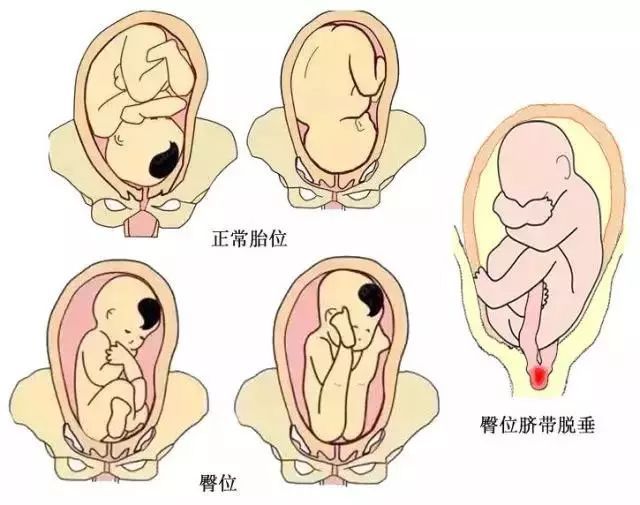 胎儿为什么臀位(胎儿为什么臀位不能顺产)